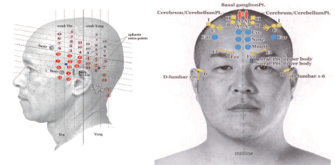 Introduction in (YNSA) Yamamoto New Scalp Acupuncture